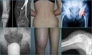Остеохондрома бедренной кости: причины, симптомы и лечение