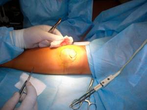 Лечение гнойного бурсита локтевого сустава: лекарства и операция