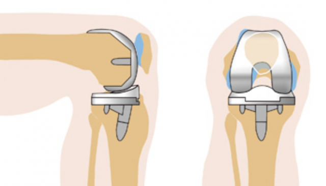 Замена коленного сустава: этапы операции, показания и подготовка