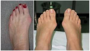 Артроз сустава большого пальца ноги: лечение