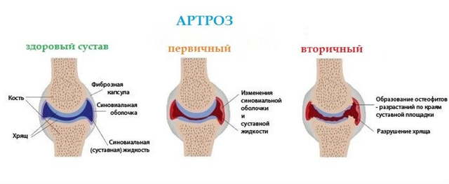 Артроз голеностопного сустава: симптомы и лечение, фото артроза голеностопа