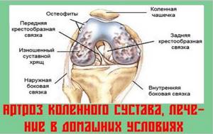 Лечение артроза коленного сустава народными средствами: рецепты