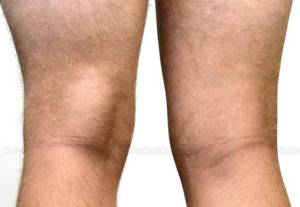 Киста Бейкера коленного сустава: причины, лечение, симптомы, фото
