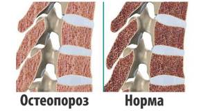 Остеопороз позвоночника: симптомы и лечение, причины