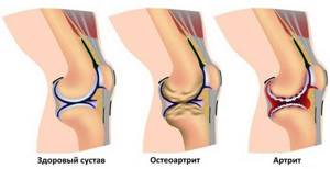 Боль в коленном суставе: причины, лечение, почему болят колени, что делать, как и чем лечить