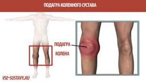 Подагра коленного сустава: причины, симптомы, диагностика, методы лечения