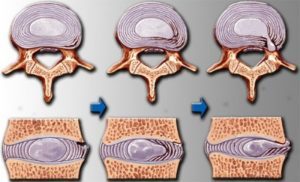 Остеохондроз шейного отдела 3 степени: причины, способы лечения