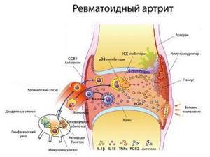 Витамины при ревматоидной форме артрита коленного сустава