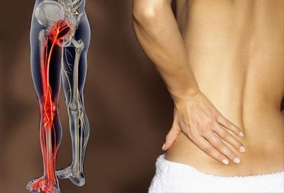 Боль в спине отдает в ногу: причины, лечение, что делать