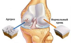 Как восстановить хрящевую ткань коленных в суставах