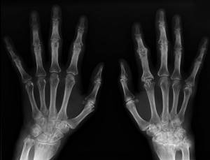 Ревматоидный артрит пальцев рук: первые симптомы, лечение, диагностика