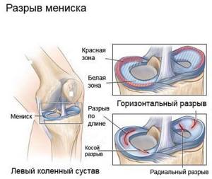 Разрыв заднего рога медиального мениска коленного сустава: лечение, симптомы, повреждение мениска