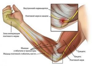 Защемление нерва в локтевом суставе: симптомы, диагностика, лечение