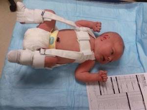 Незрелость тазобедренного сустава у новорожденных: причины и лечение