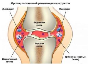 Боль в суставах и мышцах: причины, лечение, почему болят мышцы и суставы