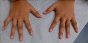 Реактивный артрит у детей: причины, симптомы, лечение, фото