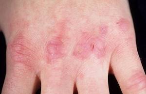 Шишки на пальцах рук: причины и лечение суставов кисти, фото