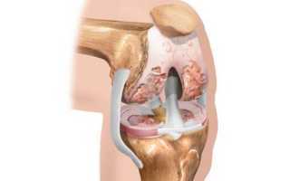 Лечение артроза коленного сустава 2 степени: симптомы, как лечить