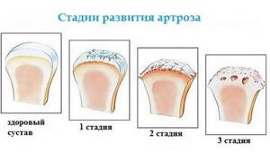 Артроз голеностопного сустава: симптомы и лечение, фото артроза голеностопа