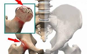 Асептический некроз коленного сустава: симптомы и лечение