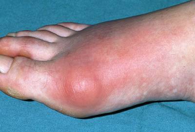 Боли в суставах ног: причины и лечение. Почему болят суставы ног?