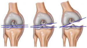 Лечение мениска коленного сустава без операции в домашних условиях
