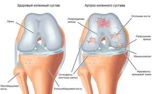 Деформирующий остеоартроз коленного сустава, лечение