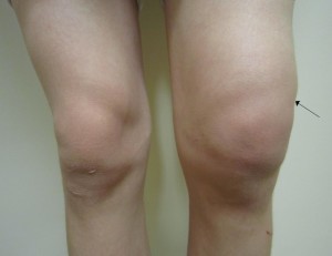 Остеоартроз коленного сустава 3 степени: лечение и операция