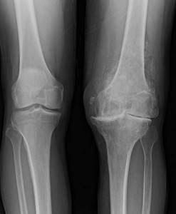 Подагра коленного сустава: причины, симптомы, диагностика, методы лечения