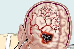 Нарушение мозгового кровообращения при шейном остеохондрозе: лечение