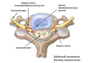 Унковертебральный артроз шейного отдела позвоночника: лечение, симптомы, причины заболевания