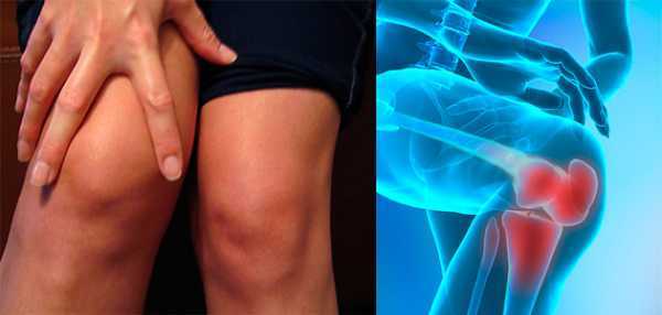 Пиявки при артрозе коленного сустава: польза и вред
