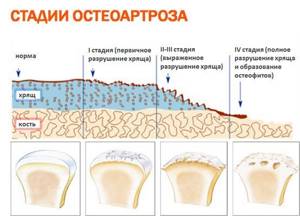 Генерализованный остеоартроз: как диагностировать и лечить