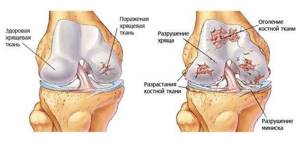 Хондропротекторы при артрозе коленного сустава: какие лучше, классификация