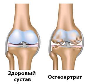 Воспаление суставов на ноге: причины, симптомы и лечение