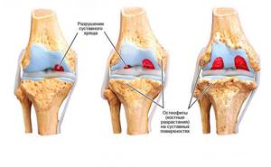 Как восстановить хрящевую ткань коленных в суставах