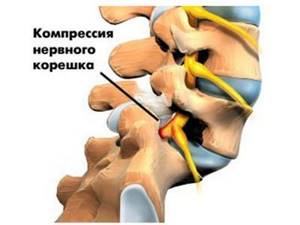 Фораминальная грыжа межпозвонкового диска: симптомы и лечение