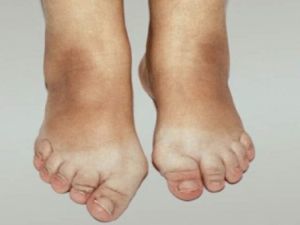 Остеоартроз стопы: симптомы и лечение мелких суставов