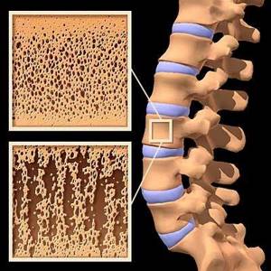 Остеопороз костей: как проверить, сопутствующие боли и лечение