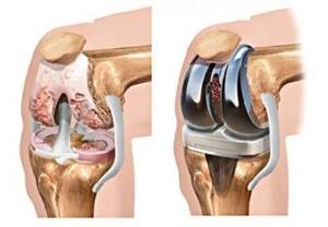 Эндопротезирование коленного сустава, отзывы после операции