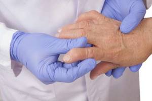 Гирудотерапия при подагре: особенности лечения суставов пиявками