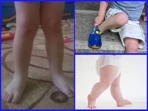 Вальгусная деформация стопы у детей: лечение методом Комаровского