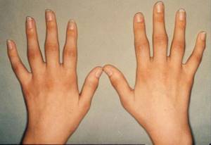 Полиартрит пальцев рук: лечение (народное, медикаментозное), симптомы, причины, диета