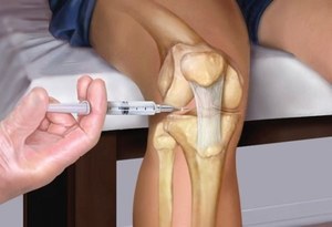 Блокада коленного сустава дипроспаном и другими медикаментами при артрозе