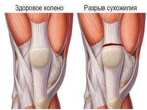 Видео: травмы коленного сустава и способы лечения