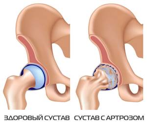 Деформирующий артроз тазобедренного сустава 2-3 степени лечение