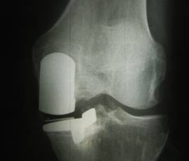 Асептический некроз коленного сустава: симптомы и лечение