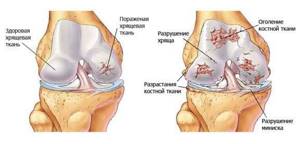 Артроз коленного сустава: симптомы и лечение, что такое, как лечить