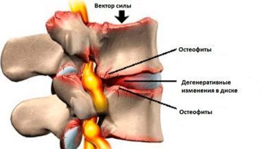 Боль под левой лопаткой сзади со спины: причины, почему болит, лечение