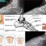 Таранно-ладьевидный сустав: причины артроза, признаки и лечение